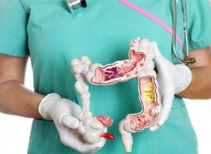 Ung thư đại tràng giai đoạn 2: Sống được bao lâu? Có chữa được không?